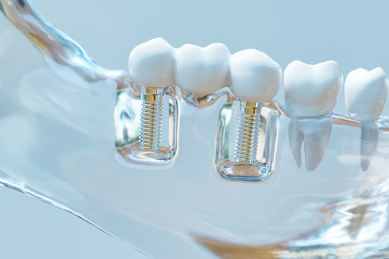 Aufnahme eines Zahnmodells mit Implantaten
