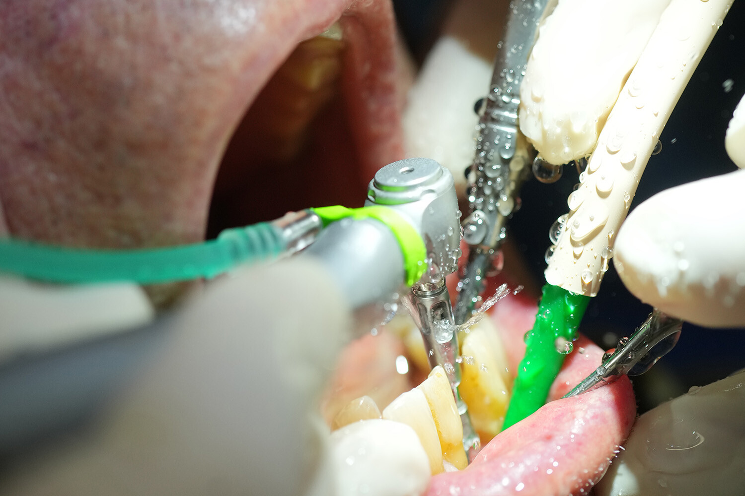 Detailaufnahme Implantatsetzung